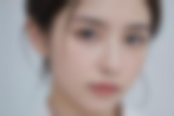 江阴曹志金医生眼鼻整形修复真实分享，自然微创审美绝了！