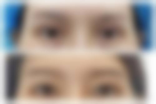 北京米兰柏羽丽都医疗美容医院面部抗衰套餐实例分享