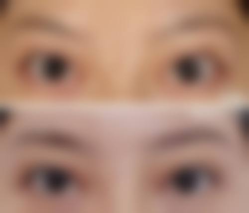 {北京米兰柏羽丽都医疗美容医院第四代热玛吉面部抗衰套餐28800元起，精准刺激胶原再生 