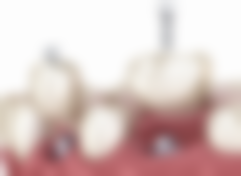 广东深圳佳誉口腔价格表（仅供参考）