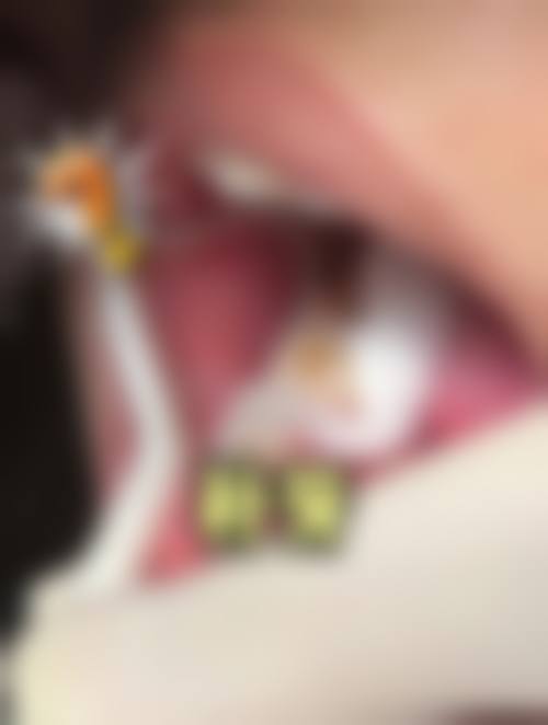 湖南长沙李秀英口腔实例参考