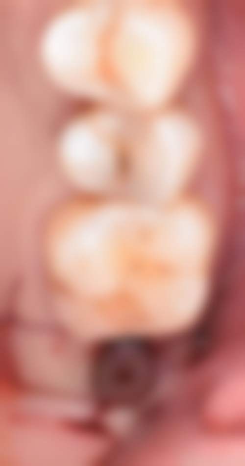 深圳粵式格倫菲爾口腔門診部价格表（仅供参考）