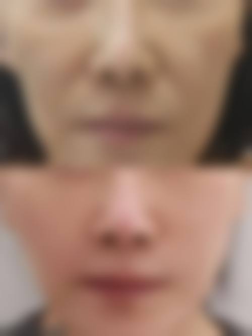 优惠活动详情:正版热玛吉+玻尿酸限时特别优惠