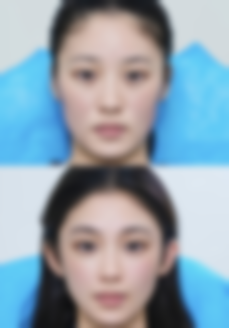 瘦脸轮廓与除皱瘦脸